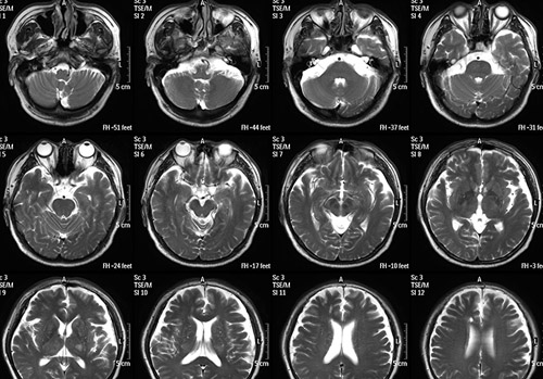 14X17XMRI 2